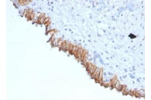 IHC testing of FFPE human bladder carcinoma with MAML2 antibody (clone MAML2/1302).