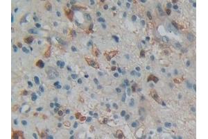 Detection of GSN in Human Glioma Tissue using Polyclonal Antibody to Gelsolin (GSN)