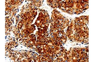 The image is immunohistochemistry of paraffin-embedded Human liver cancer tissue using ABIN7129012(COX19 Antibody) at dilution 1/50. (COX19 anticorps)