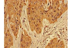 Immunohistochemistry of paraffin-embedded human cervical cancer using ABIN7142728 at dilution of 1:100 (RPL10L anticorps  (AA 1-214))