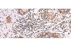 Immunohistochemistry of paraffin-embedded Human esophagus cancer tissue using ARIH2 Polyclonal Antibody at dilution of 1:80(x200) (ARIH2 anticorps)
