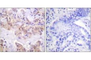 Immunohistochemistry analysis of paraffin-embedded human lung carcinoma, using C-RAF (Phospho-Ser621) Antibody. (RAF1 anticorps  (pTyr621))