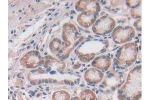 Detection of UTRN in Human Stomach cancer Tissue using Polyclonal Antibody to Utrophin (UTRN)