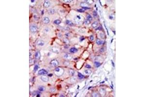Formalin-fixed and paraffin-embedded human cancer tissue (hepatocarcinoma) reacted with the primary antibody, which was peroxidase-conjugated to the secondary antibody, followed by DAB staining. (CAMK1D anticorps  (C-Term))