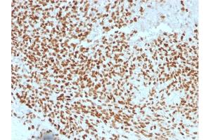 Formalin-fixed, paraffin-embedded human Ewing's Sarcoma stained with NKX2. (Nkx2-2 anticorps  (AA 1-119))