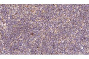ABIN6273177 at 1/100 staining Human lymph cancer tissue by IHC-P.
