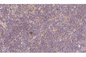 ABIN6273177 at 1/100 staining Human lymph cancer tissue by IHC-P. (Tropomodulin 1 anticorps  (N-Term))