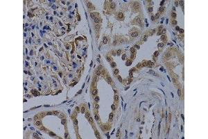 Immunohistochemistry of paraffin-embedded Human kidney cancer using WDR5 Polyclonal Antibody at dilution of 1:200 (40x lens). (WDR5 anticorps)