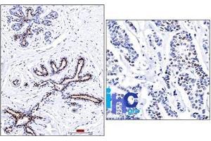 Formalin-fixed, paraffin-embedded normal human breast (left) and invasive ductal carcinoma (right) stained with progesterone receptor Ab (PR501). (Progesterone Receptor anticorps)