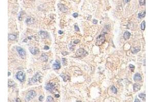 Immunohistochemical staining of formalin-fixed paraffin-embedded human liver tissue showing membrane staining with AKR1A1 polyclonal antibody  at 1 : 100 dilution. (AKR1A1 anticorps  (AA 132-310))