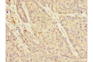 Immunohistochemistry of paraffin-embedded human ovarian cancer using ABIN7167162 at dilution of 1:100 (IQGAP3 anticorps  (AA 1437-1631))