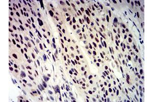Immunohistochemical analysis of paraffin-embedded rectum cancer tissues using BTRC mouse mAb with DAB staining.