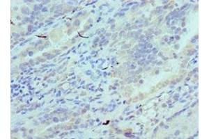 Immunohistochemistry of paraffin-embedded human lung cancer using ABIN7147246 at dilution of 1:100 (CADM1 anticorps  (AA 45-344))