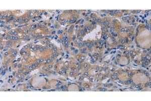 Immunohistochemistry of paraffin-embedded Human thyroid cancer using P2RX3 Polyclonal Antibody at dilution of 1:50 (P2RX3 anticorps)