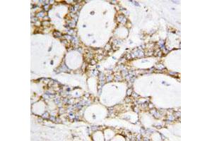 Immunohistochemical staining of paraffin embedded human breast cancer tissue section with DLD polyclonal antibody . (DLD anticorps  (C-Term))