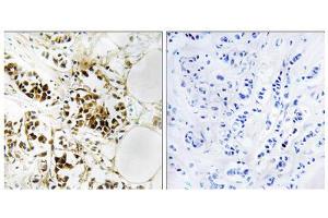 Immunohistochemistry analysis of paraffin-embedded human breast carcinoma tissue, using RGS5 antibody. (RGS5 anticorps  (Internal Region))