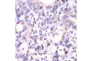 Immunohistochemistry of paraffin-embedded human gastric cancer using HAT1 antibody at dilution of 1:100 (x40 lens). (HAT1 anticorps)