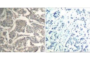 Immunohistochemical analysis of paraffin-embedded human breast carcinoma tissue using cofilin1/cofilin2 (Ab -88) Antibody (E021507). (Cofilin1/2 (CFL1/2) anticorps)