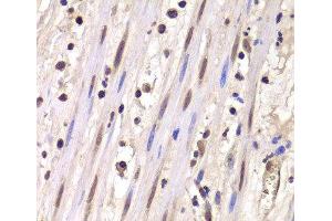 Immunohistochemistry of paraffin-embedded Human mammary cancer using LSM4 Polyclonal Antibody at dilution of 1:100 (40x lens). (LSM4 anticorps)