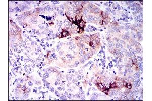 Immunohistochemical analysis of paraffin-embedded endometrial cancer tissues using SPP1 mouse mAb with DAB staining.