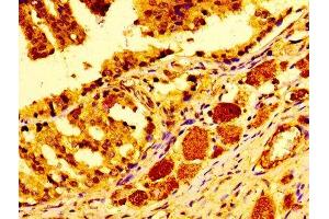 Immunohistochemistry of paraffin-embedded human prostate cancer using ABIN7147000 at dilution of 1:100
