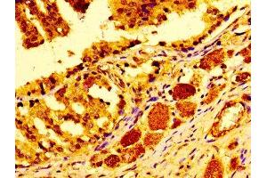 Immunohistochemistry of paraffin-embedded human prostate cancer using ABIN7147000 at dilution of 1:100 (Cathepsin D anticorps  (AA 67-403))
