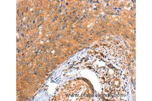 Immunohistochemistry of Human colon cancer using ACOX3 Polyclonal Antibody at dilution of 1:35