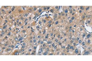 Immunohistochemistry of paraffin-embedded Human liver cancer using TRIP4 Polyclonal Antibody at dilution of 1:50