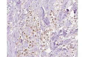 ABIN6266828 at 1/100 staining human Breast cancer tissue sections by IHC-P.