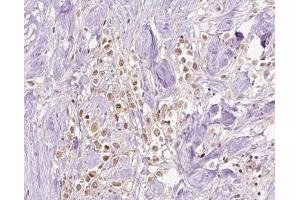 ABIN6266828 at 1/100 staining human Breast cancer tissue sections by IHC-P. (VPS72 anticorps  (Internal Region))