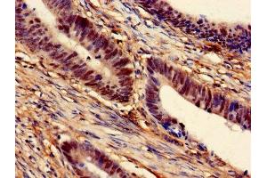 Immunohistochemistry of paraffin-embedded human colon cancer using ABIN7168530 at dilution of 1:100 (MAT2A anticorps  (AA 1-395))