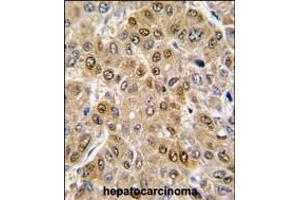 Formalin-fixed and paraffin-embedded human hepatocarcinoma tissue reacted with DDX5 antibody , which was peroxidase-conjugated to the secondary antibody, followed by DAB staining. (DDX5 anticorps  (C-Term))