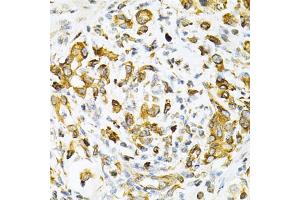 Immunohistochemistry of paraffin-embedded human gastric cancer using TAPBP Antibody (ABIN1875423) at dilution of 1:200 (40x lens). (TAPBP anticorps)
