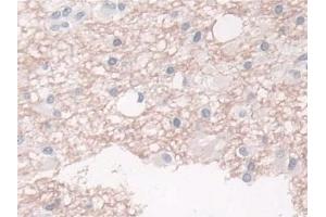 Detection of BCAR1 in Human Glioma Tissue using Polyclonal Antibody to Breast Cancer Anti-Estrogen Resistance 1 (BCAR1)