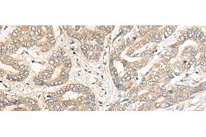 Immunohistochemistry of paraffin-embedded Human liver cancer tissue using PCDHGB5 Polyclonal Antibody at dilution of 1:40(x200) (PCDHGB5 anticorps)