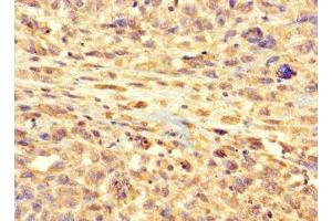 Immunohistochemistry of paraffin-embedded human melanoma using ABIN7167050 at dilution of 1:100 (RSPH9 anticorps  (AA 62-171))