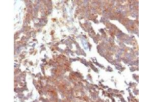 IHC testing of FFPE human ovarian carcinoma and GnRHR antibody (clone LCHR37) (GNRHR anticorps)