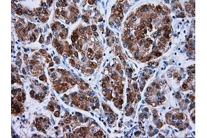 Immunohistochemical staining of paraffin-embedded Carcinoma of liver tissue using anti-HSD17B10mouse monoclonal antibody. (HSD17B10 anticorps)