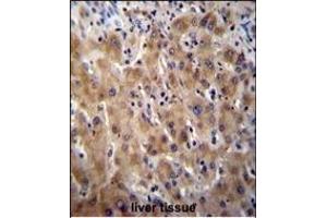 Glypican 3 (GPC3) Antibody (N-term) (ABIN390317 and ABIN2840749) immunohistochemistry analysis in formalin fixed and paraffin embedded human liver tissue followed by peroxidase conjugation of the secondary antibody and DAB staining.