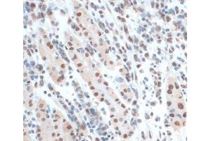 Immunohistochemistry of paraffin-embedded Human gastric cancer using ZNF433 Polyclonal Antibody at dilution of 1:100 (40x lens). (ZNF433 anticorps)