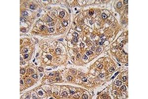 IHC analysis of FFPE human hepatocarcinoma tissue stained with AKR1A1 antibody