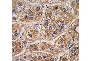 IHC analysis of FFPE human hepatocarcinoma tissue stained with AKR1A1 antibody (AKR1A1 anticorps  (AA 293-325))