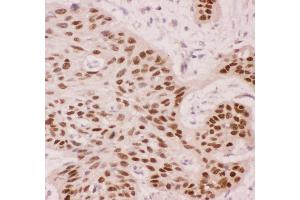 Anti-p63 Picoband antibody,  IHC(P): Human Oesophagus Squama Cancer Tissue