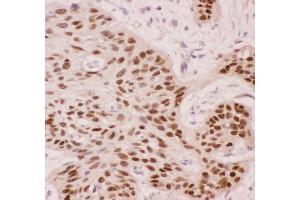 Anti-p63 Picoband antibody,  IHC(P): Human Oesophagus Squama Cancer Tissue (p63 anticorps  (AA 311-680))