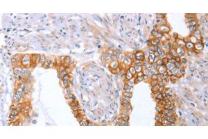 Immunohistochemistry of paraffin-embedded Human cervical cancer tissue using ABO Polyclonal Antibody at dilution 1:50 (ABO anticorps)