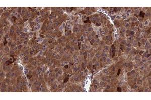 ABIN6277108 at 1/100 staining Human liver cancer tissue by IHC-P.