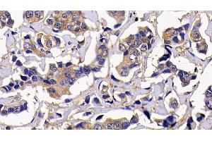 Detection of RIPK1 in Human Breast cancer Tissue using Polyclonal Antibody to Receptor Interacting Serine Threonine Kinase 1 (RIPK1) (RIPK1 anticorps  (AA 17-289))