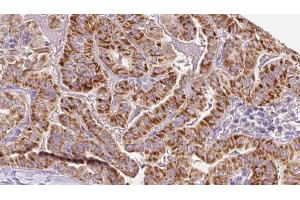 ABIN6267077 at 1/100 staining Human thyroid cancer tissue by IHC-P. (RYR2 anticorps  (pSer2814))