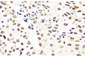 Immunohistochemistry of paraffin-embedded Human lung cancer using TIA1 Polyclonal Antibody at dilution of 1:100 (40x lens). (TIA1 anticorps)