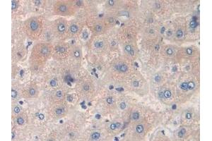 Detection of PALB in Human Liver cancer Tissue using Polyclonal Antibody to Prealbumin (PALB)